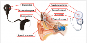 Cochlear Implant 01 300x151 1 - درمان های گوش وحلق وبینی