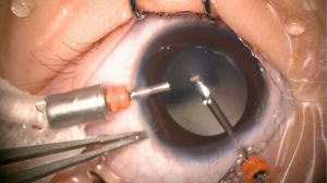 vitrectomy 01 300x168 1 - درمان های چشم